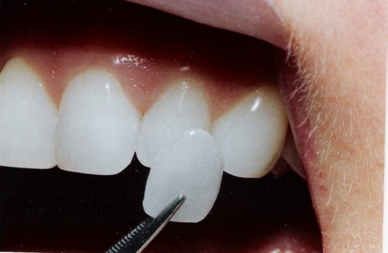 Tooth Bleaching With Or Without Peroxide